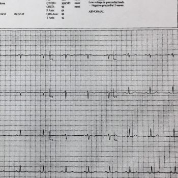Printed paperwork from my cardiologist showing the rhythm of my heart beat